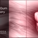 Laser Gum Surgery