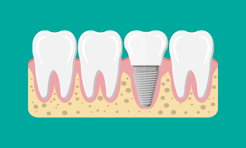 Success Rate of Dental Implant