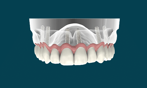 Tooth Implants