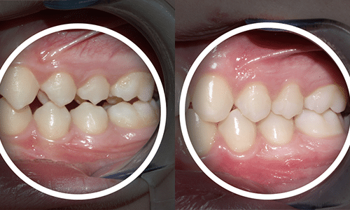 Causes of Malocclusion