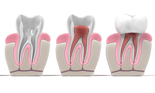 Alternative to Root Canal Treatment