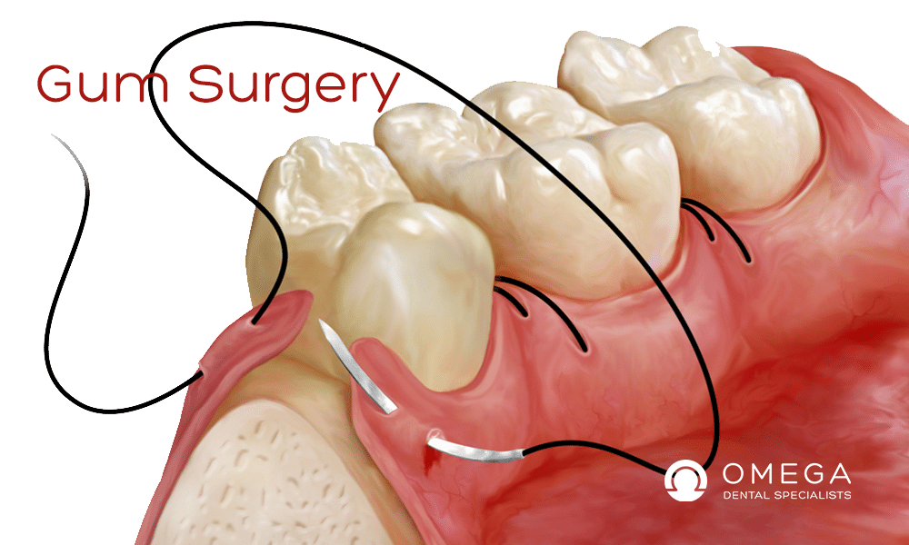 Cost of Alveoloplasty