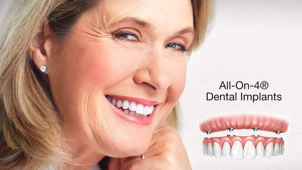 All-on-4 Dental Implants