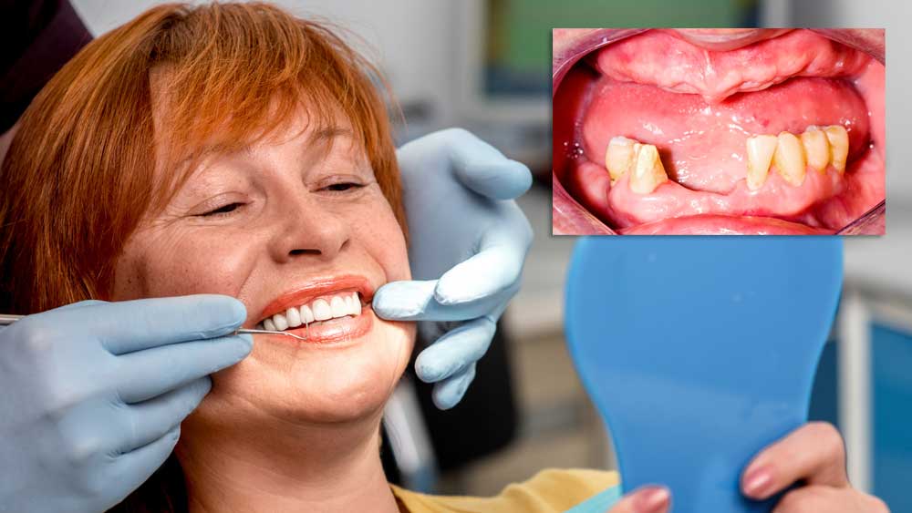 dental implants in Houston