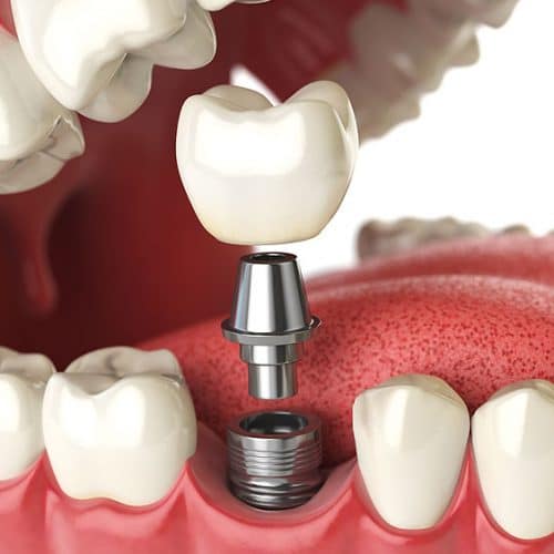 Loose Dental Implants