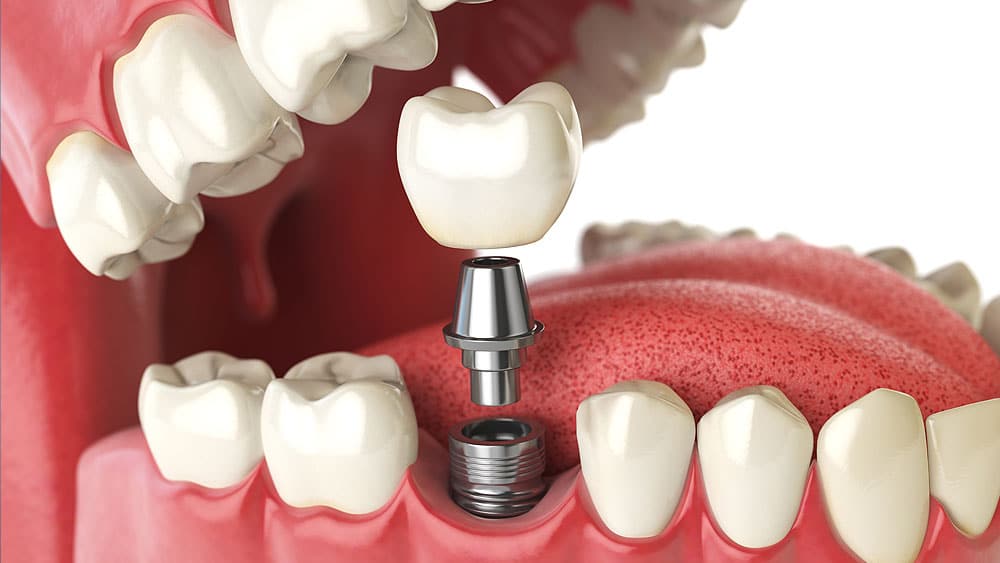 Single Tooth Implants