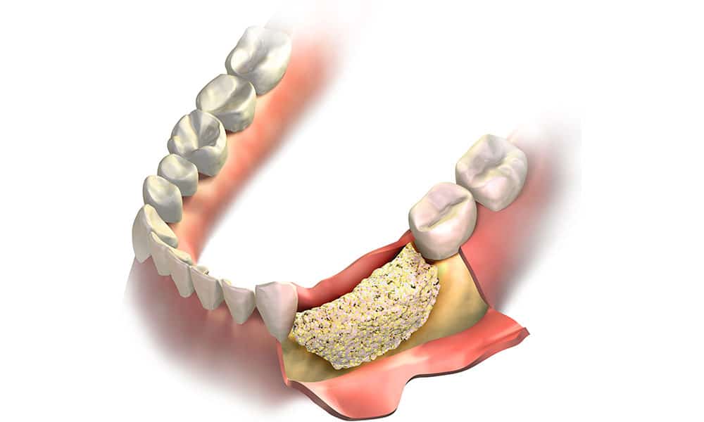 Apicoectomy