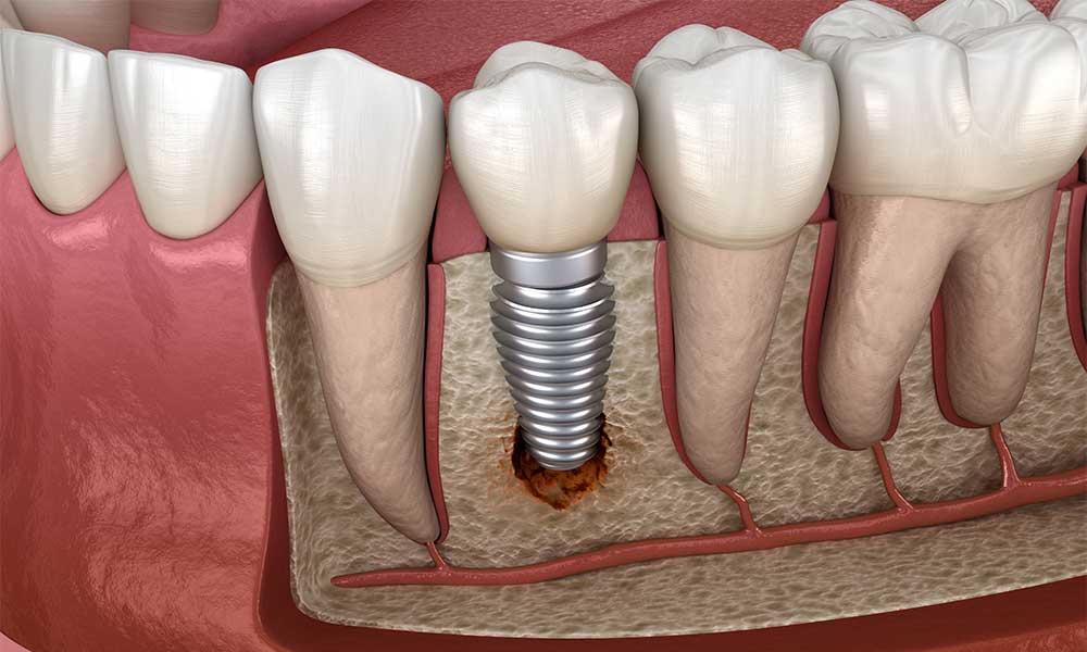 dental implant