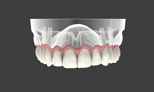 Overdenture