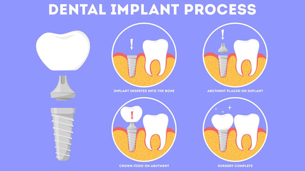 how does teeth implants work