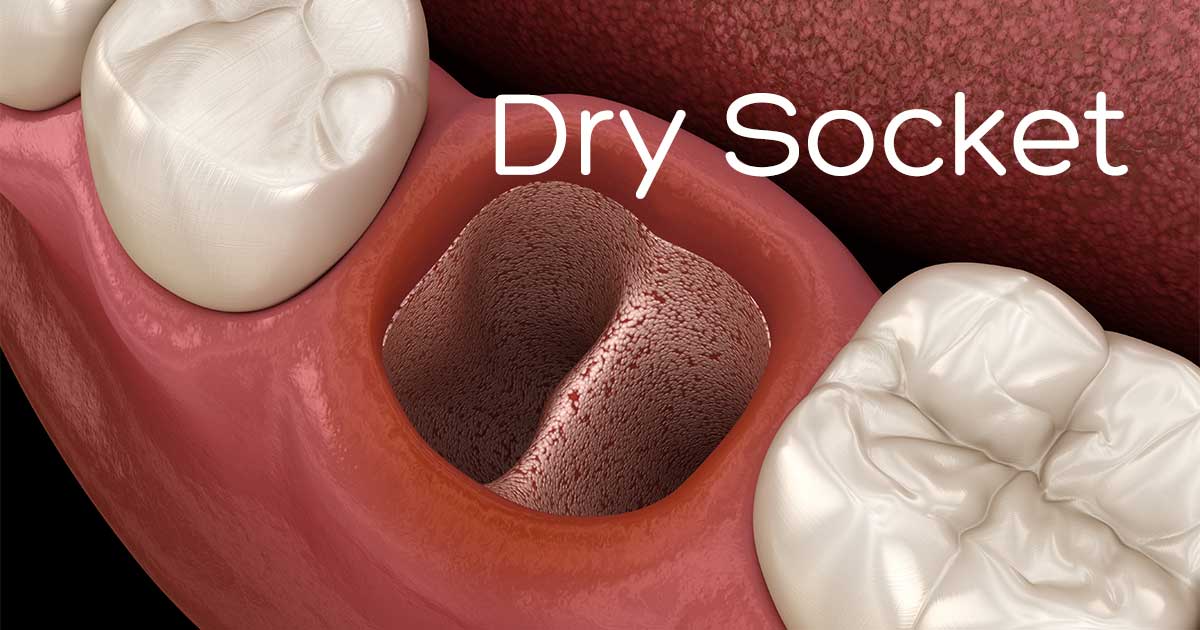 dry socket