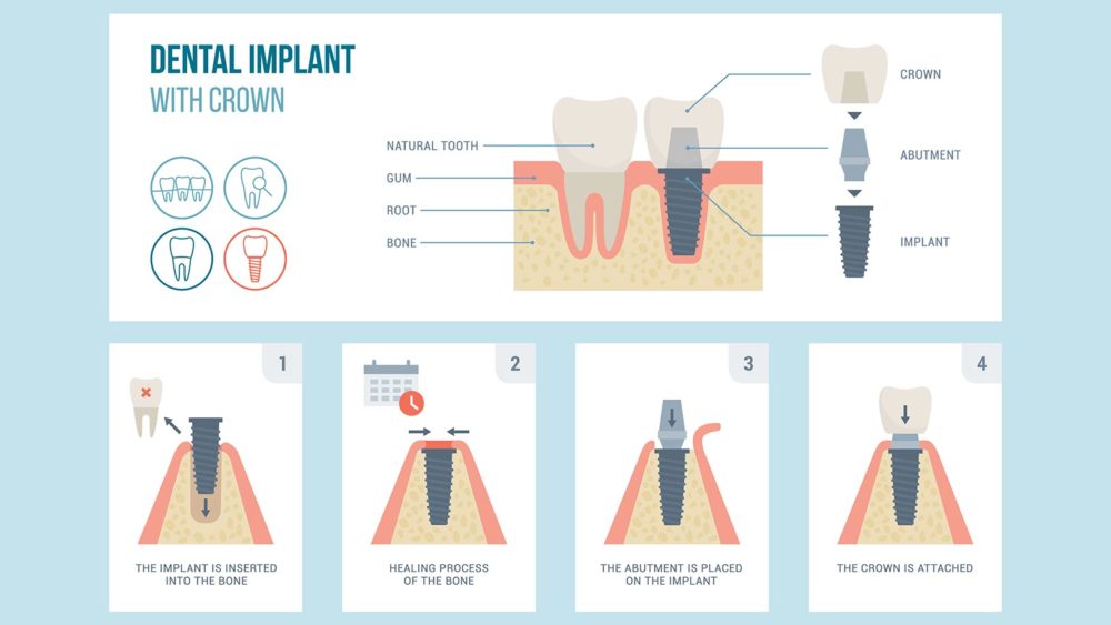 Dental Implants Process