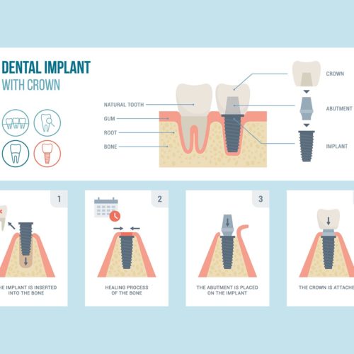 Dental Crowns