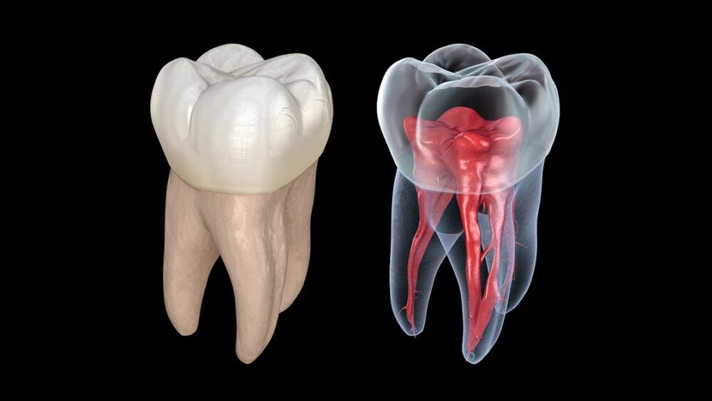 ct scan for root canal