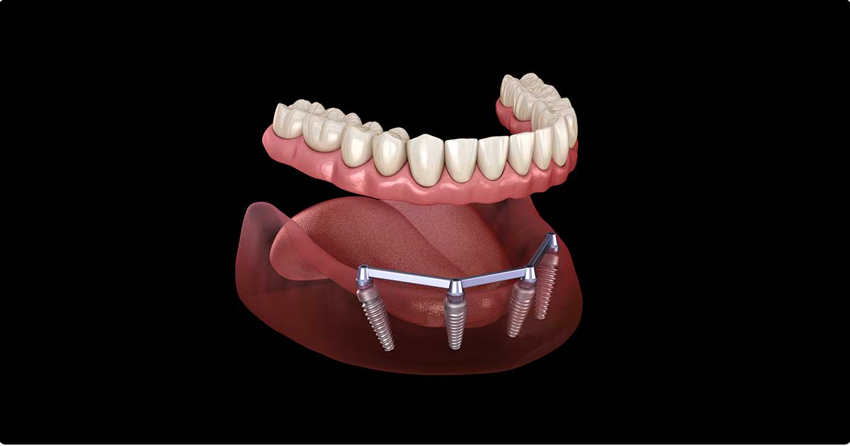 cost of snap on dentures