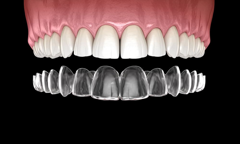 invisalign houston