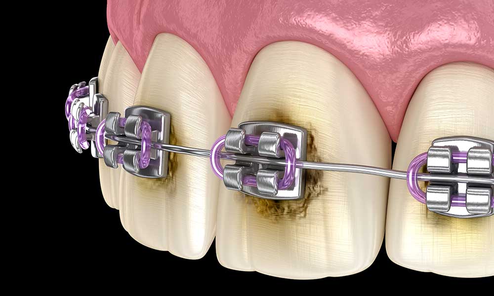 cleaning braces