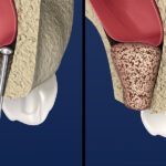 Dental Bone Graft Cost, Materials and Procedure