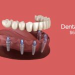 Full Mouth Dental Implants Cost and Procedure