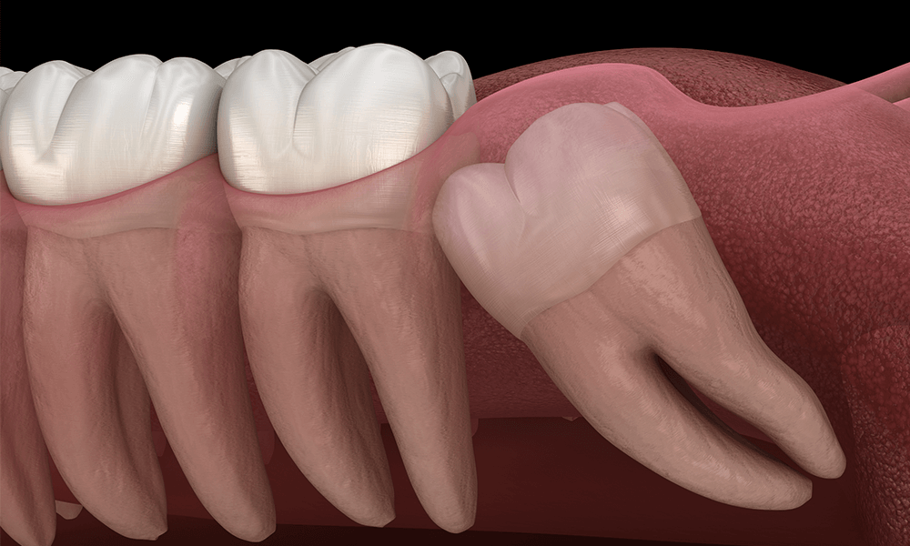 wisdom tooth removal