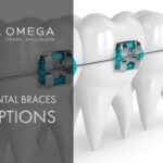 cost of metal braces in Houston