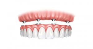 Full Mouth Dental Implants