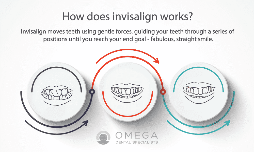 Invisalign Work