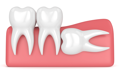 Impacted-tooth-Houston