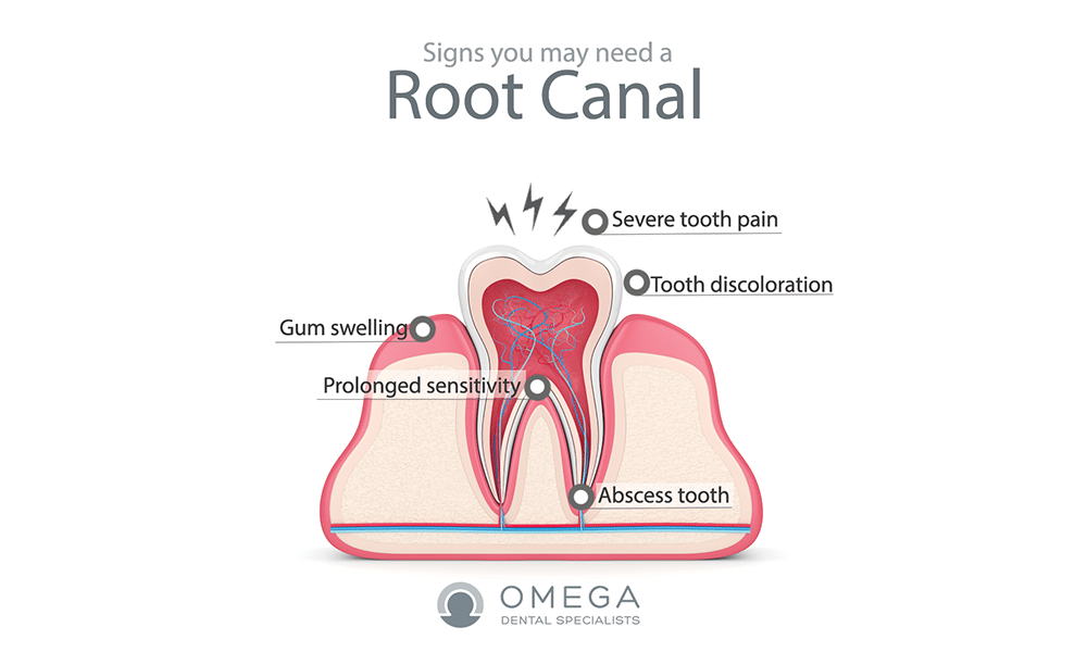 why do you need root canal