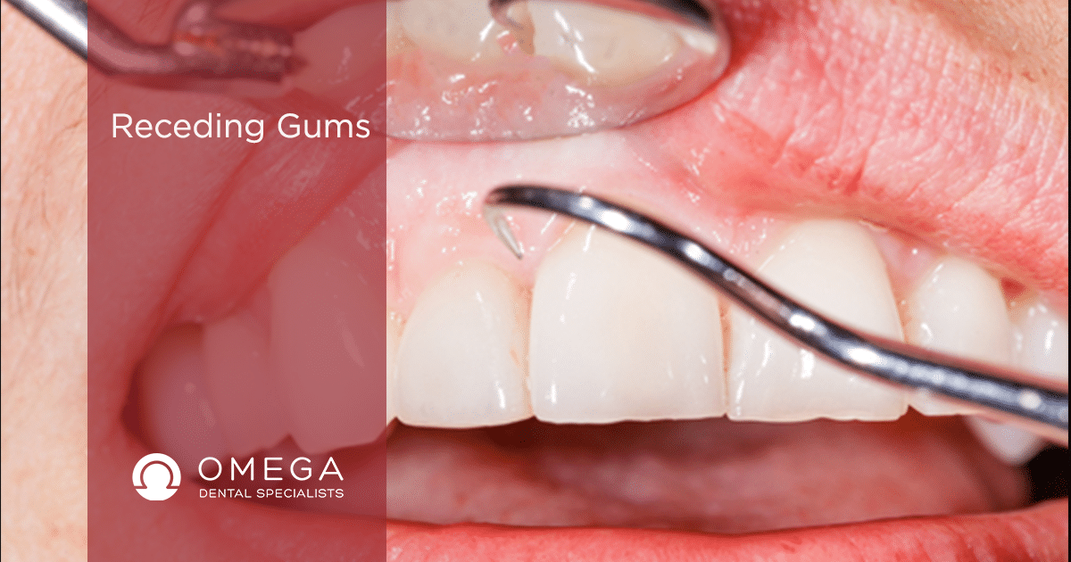 Receding gums