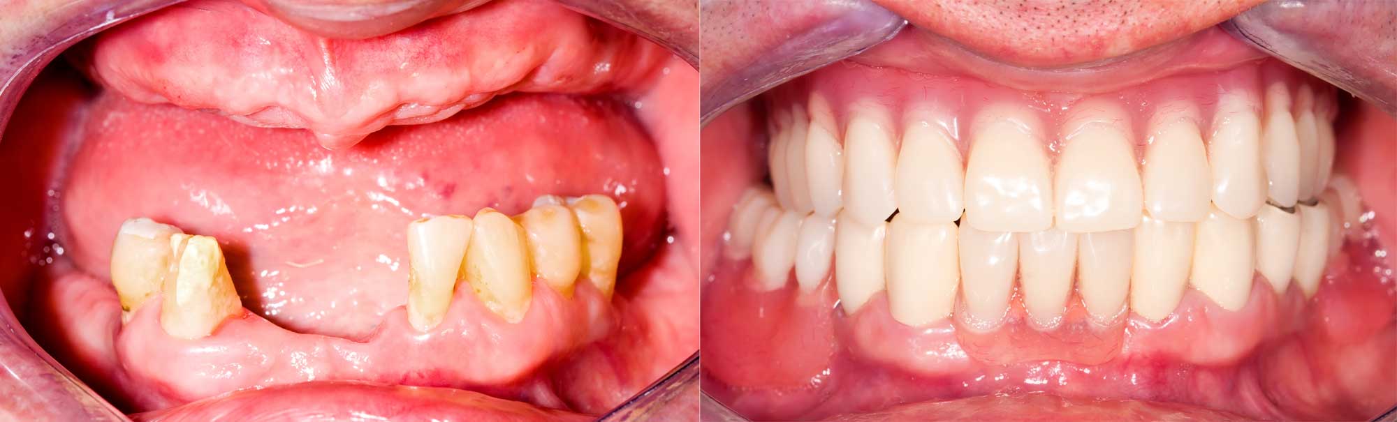 Same day dental implants