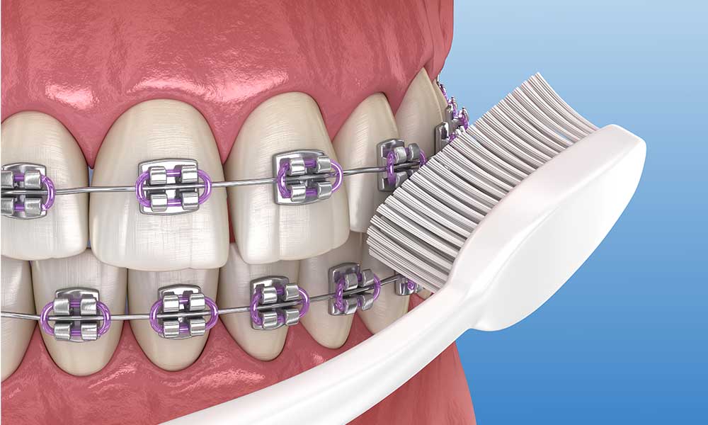 brush braces