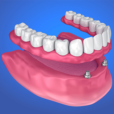 dental implant overdenture