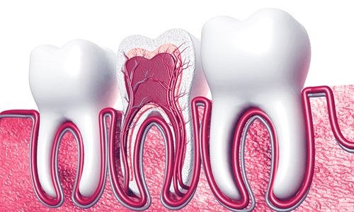 root-canal-omega-dental-Houston