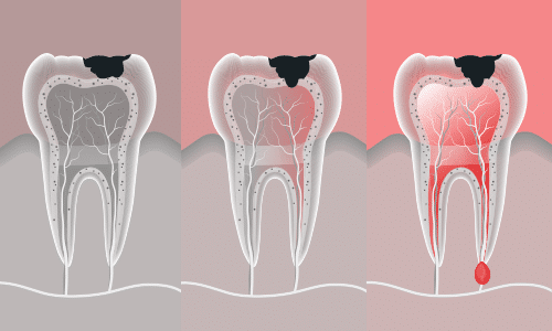 root-canal-treatment-Houston