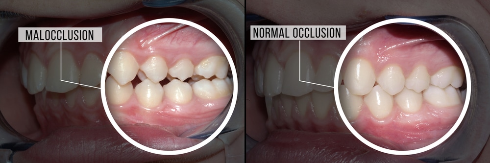 Malocclusion-Omega-Dental-Houston