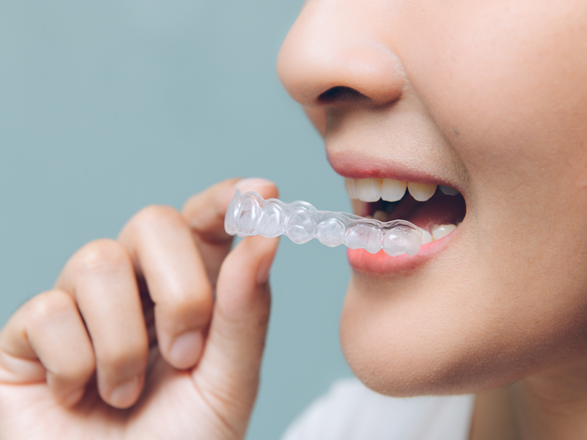 Invisalign Houston