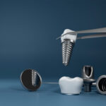 Dental Implant