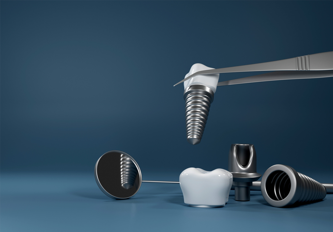 Dental Implant